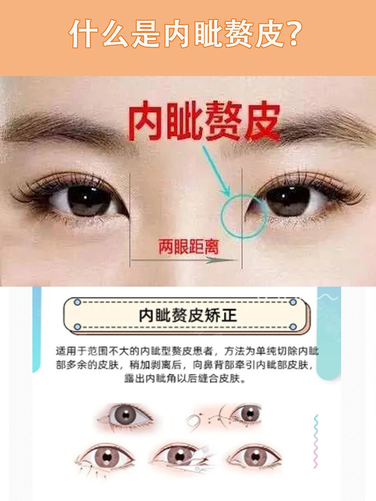 内眦赘皮1.jpg